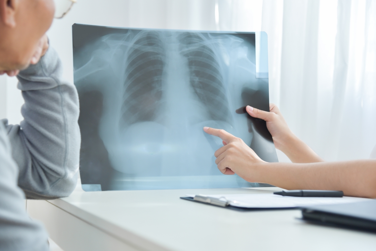 doctor discussing lung xray with patient